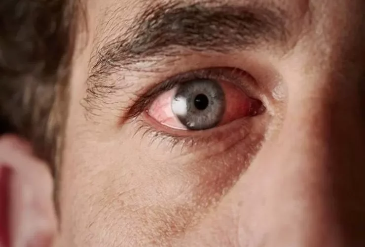 علامات تؤكد حدوث مشاكل في شبكية العين منها انفصال الشبكية عند مرضى السكري