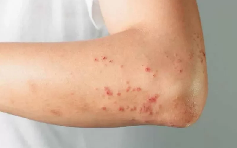 اسرع الى الطبيب إذا رأيت هذه العلامات في الجلد