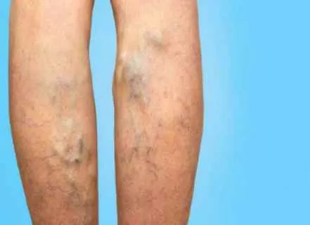 كيف تعرف انك تعاني من دوالي الساقين وطرق العلاج منها ؟