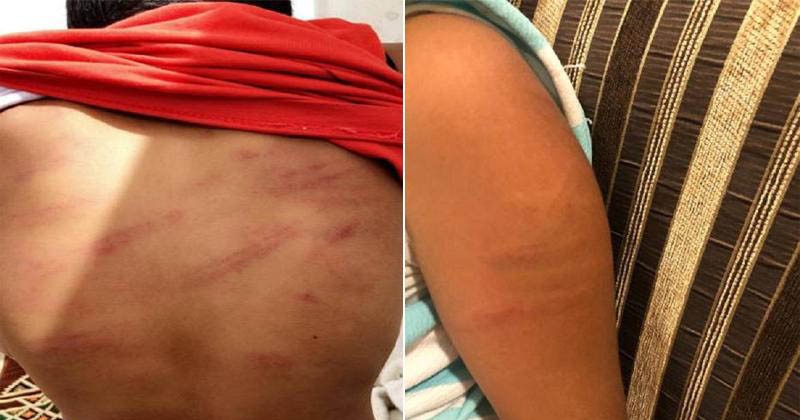 ضرب وخنق وتهديد بالقتل.. بالصور: زوجة تكشف تفاصيل تعذيبها وأطفالها على يد زوجها بالدمام