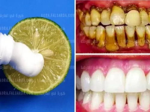 طريقة عمل الخلطة المنزلية الفعالة لتبييض الأسنان في ثلاثة ايام فقط