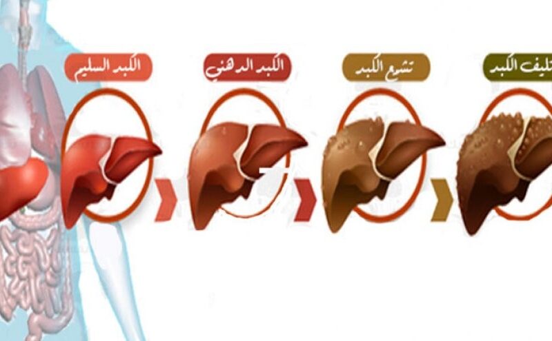 إذا ظهرت عليك هذه الأربع العلامات فأنت مصاب بأحد أمراض الكبد الخطيرة حتى لولم تشعر بأي ألم!