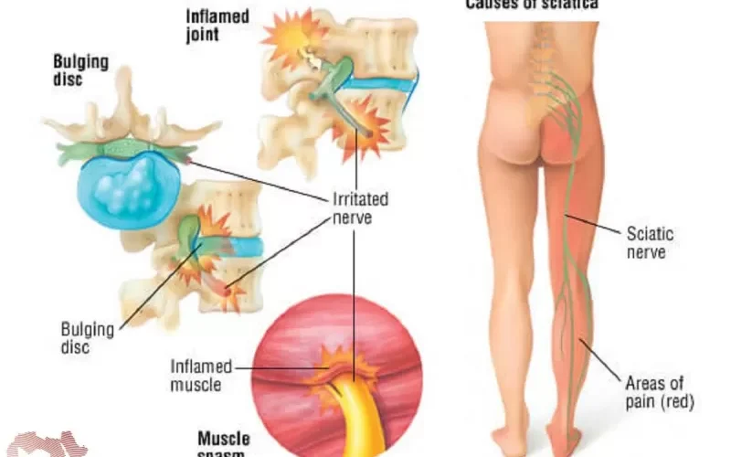 حقائق واسرار ستدهشك عن عرق النسا .. اسبابه وطرق اكتشافه وعلاجه
