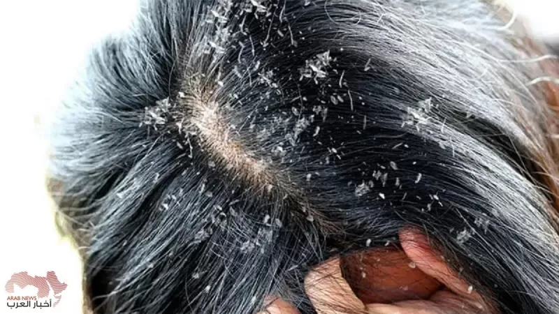 هذا هو السبب الحقيقي لقشرة الشعر ووصفة طبيعية معجزة تخلصك منها وتحافظ على قوة شعرك ولونه بعيداً عن الشيب والشعر الأبيض