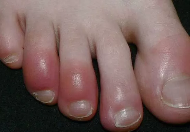 قاتل صامت.. تغير أظافر قدميك دليل أنك مصاب بهذه الحالة الخطيرة