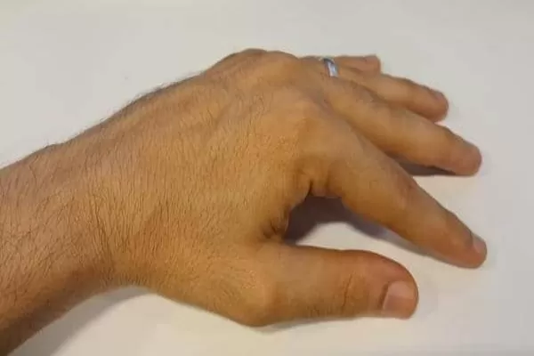 هذه العلامات على يديك تؤكد اصابتك بالقاتل الصامت عند الرجال