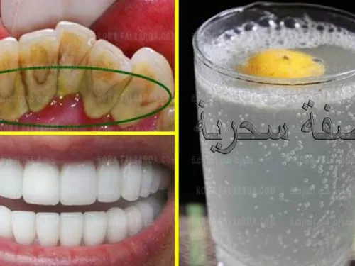 طريقة عمل محلول تبيض الأسنان في المنزل من مكونات سهلة ورخيصة والنتائج مضمونة وقل وداعاً لاصفرار الأسنان