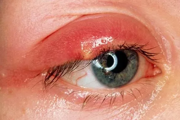 من بعد اليوم لا داعي للذهاب إلى الطبيب .. علاجات منزلية سهلة للتخلص من جنجل العين