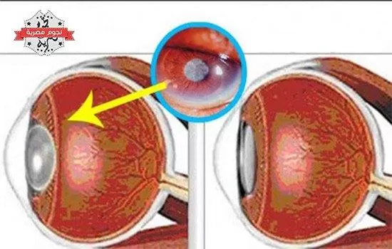 المشروب الخارق لتقوية النظر وحماية العين خاصة عند مرضى السكري