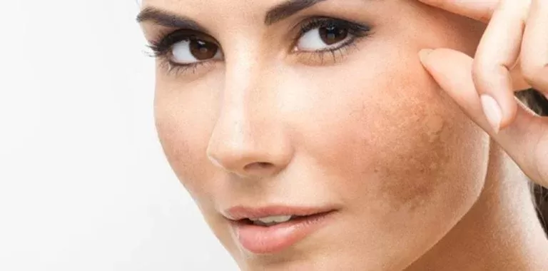 بسبب أنه يحتاج عناية خاصة إليك سيدتي أشهر المكونات التي تخلصك من الكلف نهائياً