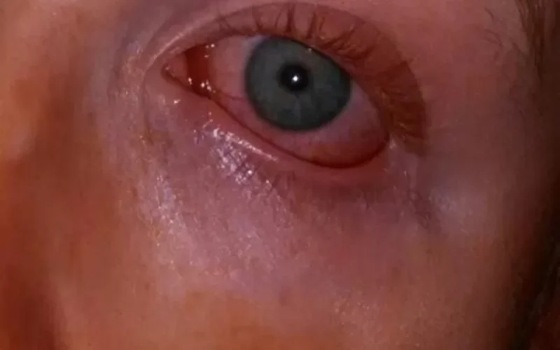 إذا كنت تعاني من جفاف العين اليك هذه النصائح الذهبية لعلاجه قبل أن يسبب تلف القرنية