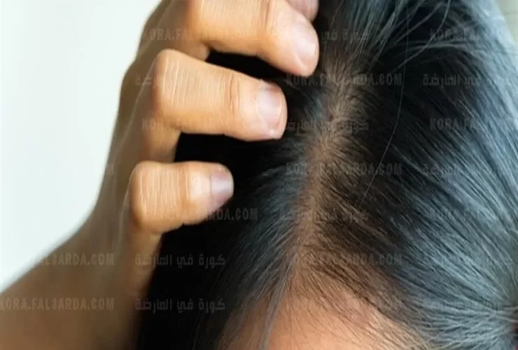 الخلطة السحرية لملأ فراغات الرأس بالشعر ووقف التساقط ومحاربة الصلع بمواد طبيعية رخيصة الثمن خلال اسبوع واحد فقط