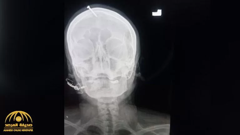 لتنجب ولد ذكر طرق مسمار بين عينيها بموافقة زوجها