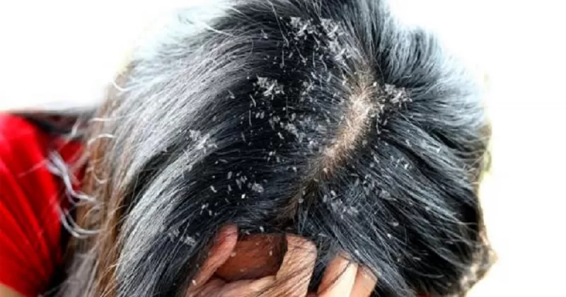 إليك أسباب ظهور قشرة الرأس وكيفية التخلص منها بطرق بسيطة وغير متوقعة ؟