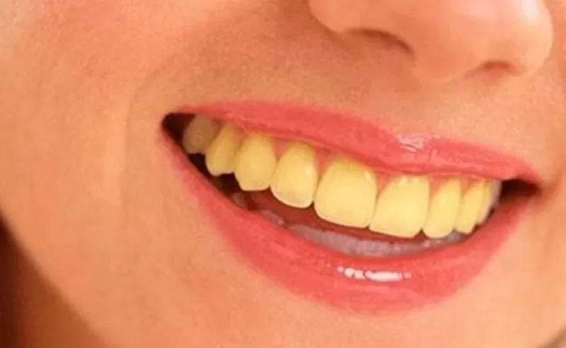 علامة واضحة تظهر في الصباح عند تنظيف اسنانك تؤكد انك تعاني من نقص حاد وخطير في اهم فيتامين قد تسبب خسارة حياتك