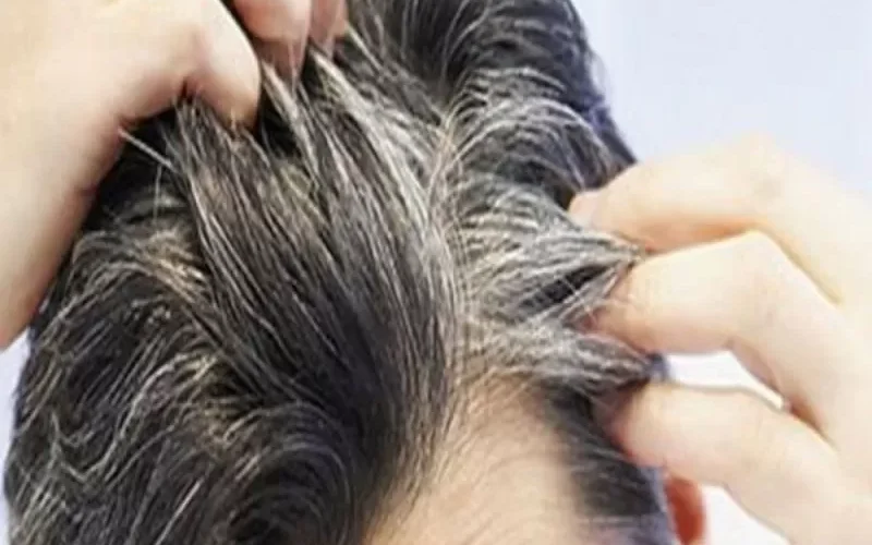 نقص هذا الفيتامين في جسمك يسبب الشيب والشعر الأبيض وسيختفي فوراً عندما تعوض هذا النقص