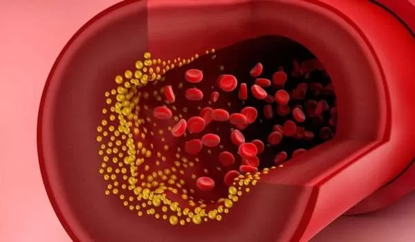 هكذا يبدو وجهك عند ارتفاع الكوليسترول في الدم