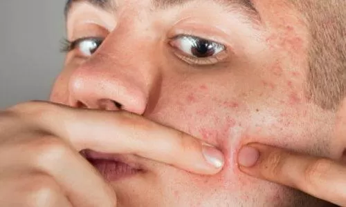 علاج حب الشباب نهائياً بهذه الوصفات المنزلية