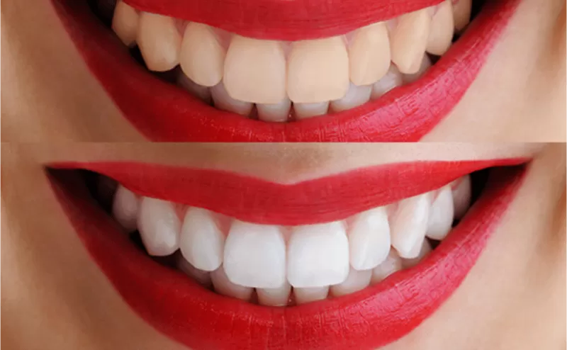 قشور هذه الفاكهة معجزة حقيقية لتبييض الأسنان والتخلص من الصفار والبقع على اسنانك والنتائج ادهشت الاطباء