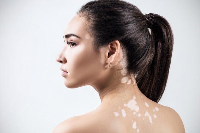 أسباب البهاق المفاجىء