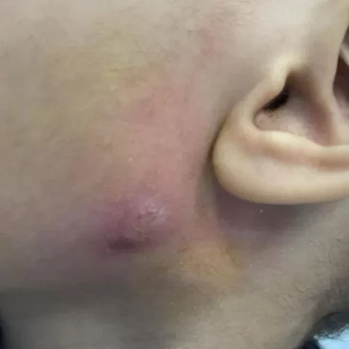 صدم الأطباء .. استخراج دودة من وجه طفل في السعودية وطولها كبير ومفزع (صورة)