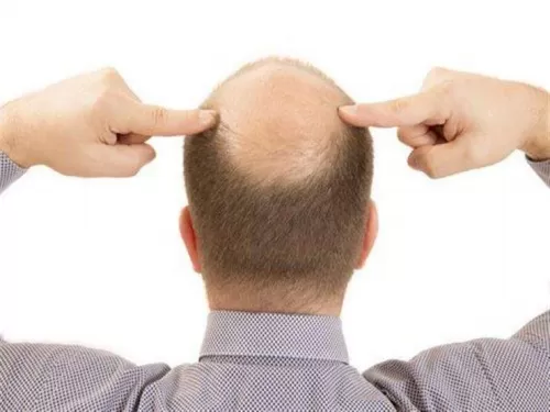 تجنبها: هذه هي اسباب الصلع المبكر
