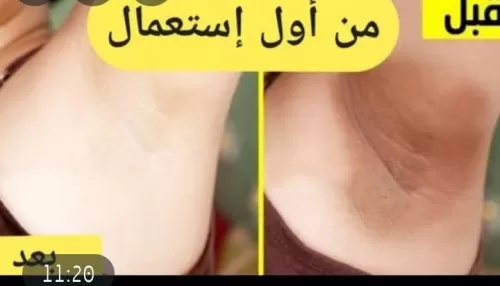 خلطة سوريا مشهورة لتبييض الابط وإزالة سواد الإبطين من اول استعمال بمكونات سهلة