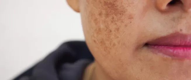 مـــا هو كلف الوجه وكيف يحدث وما هي طرق علاجه الحديثة ؟