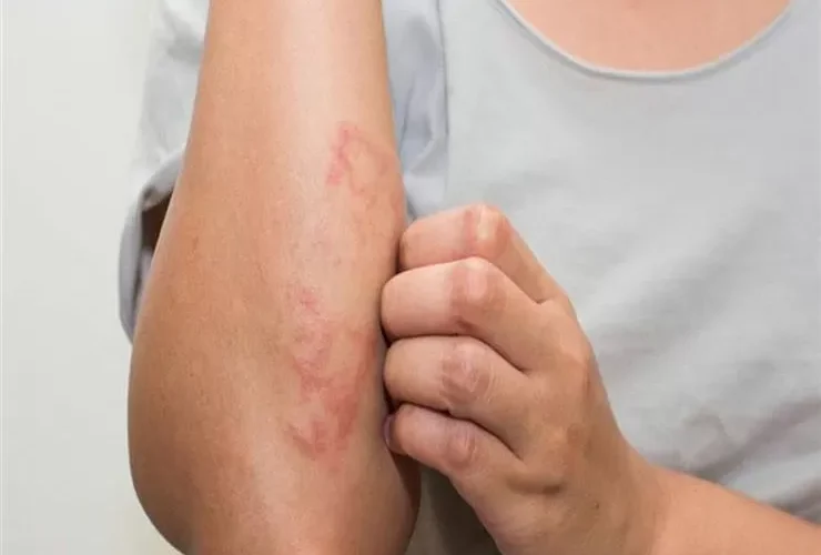 نداء استغاثة يطلقه جسمك بسبب ارتفاع السكر التراكمي واطباء يحذرون من تجاهلها