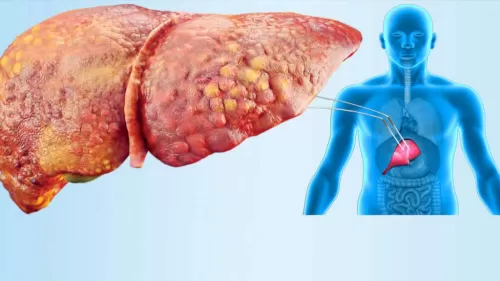 أعراض هامة لا تتجاهلها فقد تكون إشارة لإصابتكم بمرض الكبد الدهني