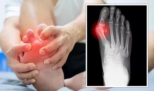 4 خطوات ينصح بها الاطباء  لتخفيف آلام نوبات “النقرس”!