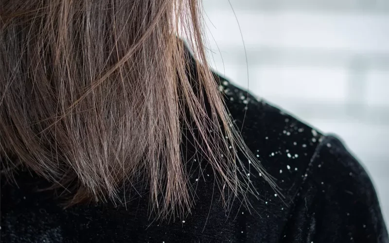 بطريقة لم يخبرك بها احد من قبل .. تخلص من قشرة الشعر بطريقة مضمونة خلال دقائق