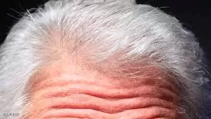 بينها  أمراض القلب .. ظهور الشيب وإشارات مفاجئة تنذر بمخاطر صحية