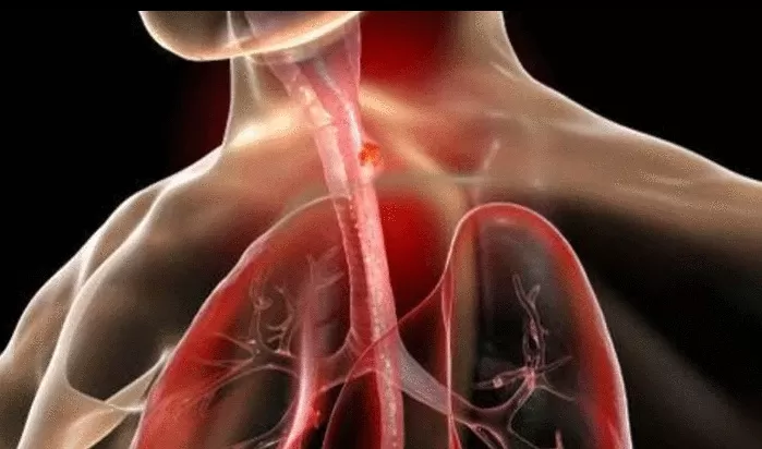 احذر.. علامة مبكرة لسرطان المرئ تظهر أثناء تناول الطعام .. تعرف عليها وانقذ نفسك قبل فوات الأوان؟
