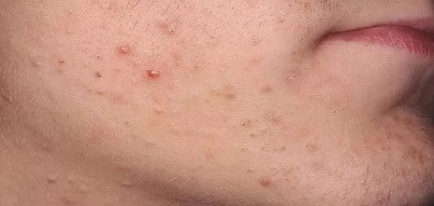 طريقة طبيعية رخيصة وبسيطة لعلاج الحبوب على الوجه والتخلص من اثارها نهائياً