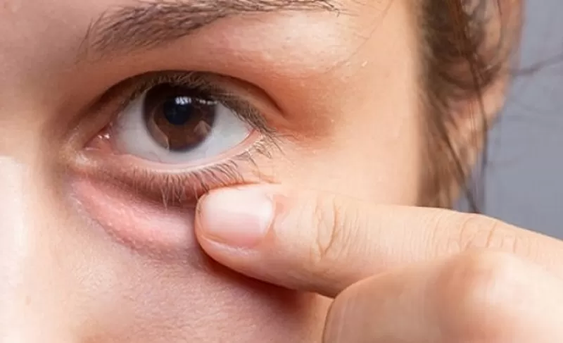 علامات تظهر على العين تشير إلى إصابتك بورم خبيث احذر قبل فوات الاوان..