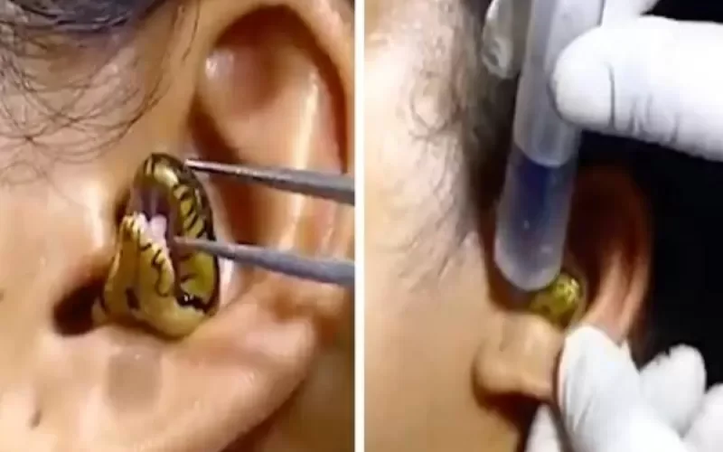 لن تصدق ما تراه.. شاهد: طبيب يتفاجأ بوجود ” ثعبان” داخل أذن امرأة.