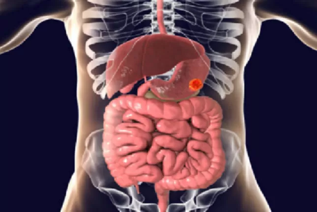 هذه هي الاعراض المبكرة لسرطان المعدة