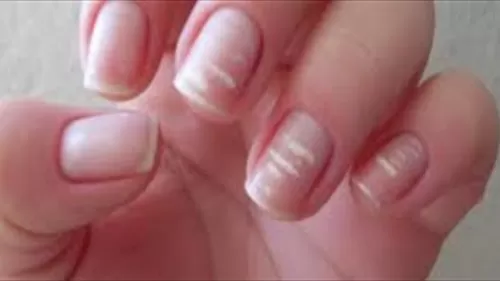 علامات على الاظافر كل واحدة منها تدل على نقص فتامين معين .. تعرف عليها