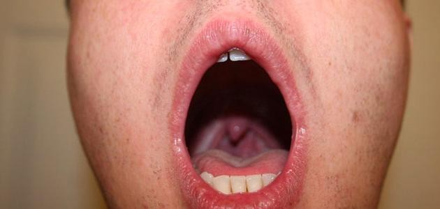 ما هي أعراض التهاب الحلق؟ وكيف يمكن علاجها؟