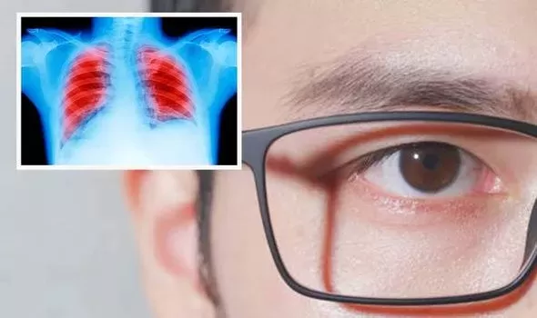 تحذير خطير للمدخنين من علامات تظهر في العين تدل على بداية تكون سرطان الرئة