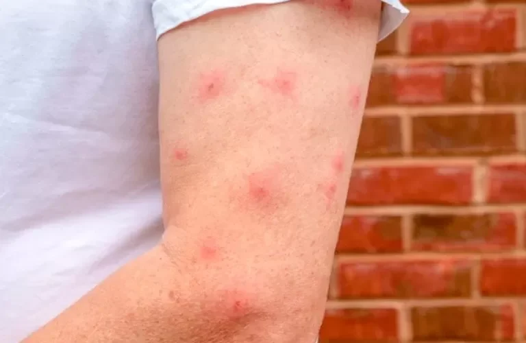 حقائق مرعبة .. لهذا السبب يختار البعوض بعض الناس ولا يقترب من أخرين