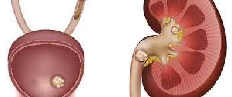 القضاء على املاح الكلى وتفتيت الحصوات خلال ايام فقط مع هذه العشبة الخارقة التي يوصي بها الاطباء