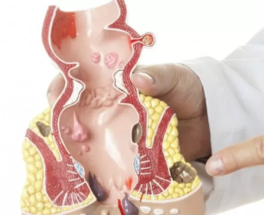 قل وداعًا للبواسير.. علاج منزلي مضمون بدون تدخل جراحي