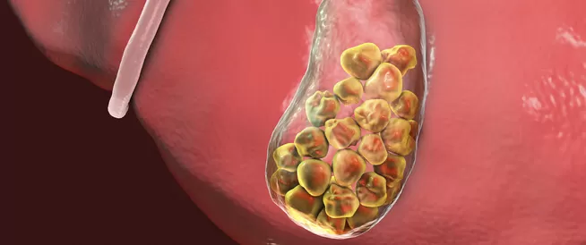 اعــراض تؤكد انك مصاب بحصوات المرارة وليس شيء اخر