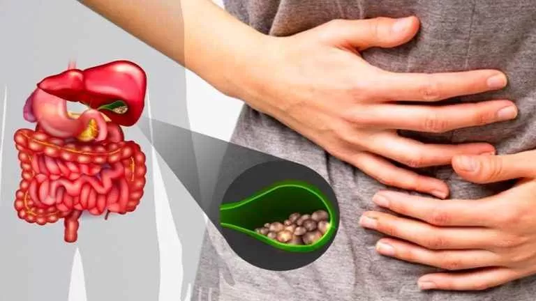 الوصفة الطبيعية التي ينصح بها الاطباء لعلاج حسوات المرارة
