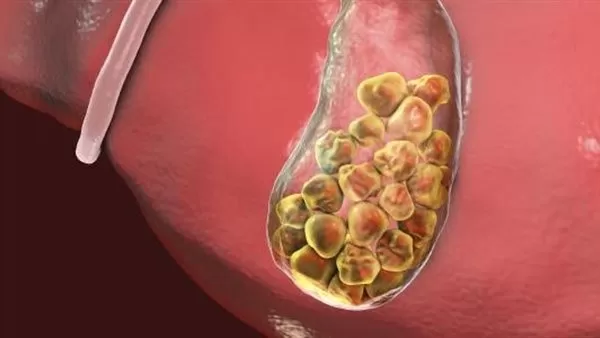 المشروب المعجزة لتفتيت حصوات الكلى من المنزل دون اي حاجة للأدوية او العمليات وهذه هي طريقة تحضيره بالشكل الصحيح