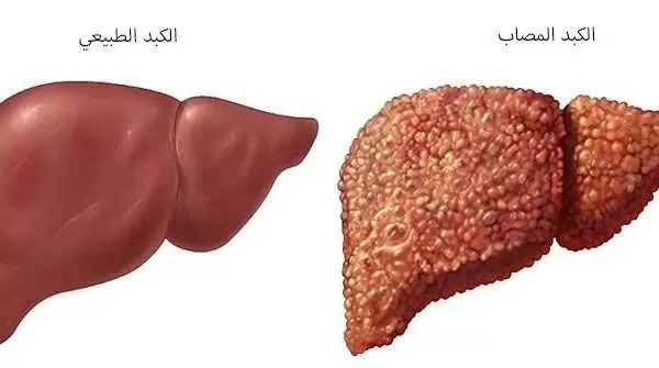 تحذير خطير من سبع عادات يومية تؤدي الى تلف الكبد