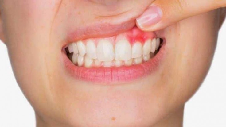 أسباب التهاب اللثة مختلفة
