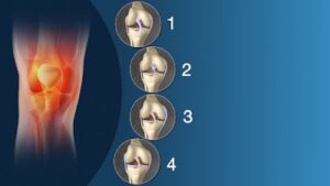 أعراض تمزق الأربطة